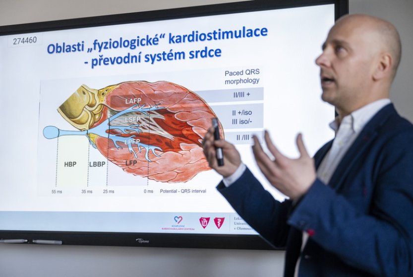 Nová metoda zavádění kardiostimulátorů je má víc přiblížit běžné činnosti srdce
