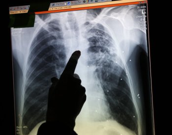 Lékař: Všechna vyšetření při podezření na nádor plic by měla být do měsíce
